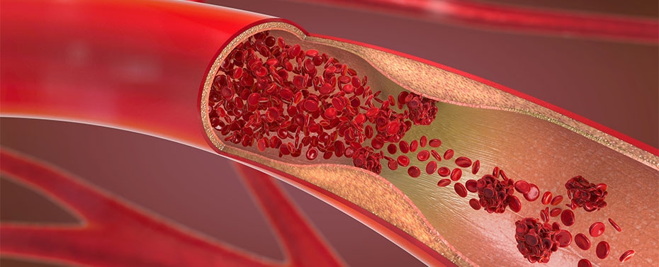 illustration of constricted artery